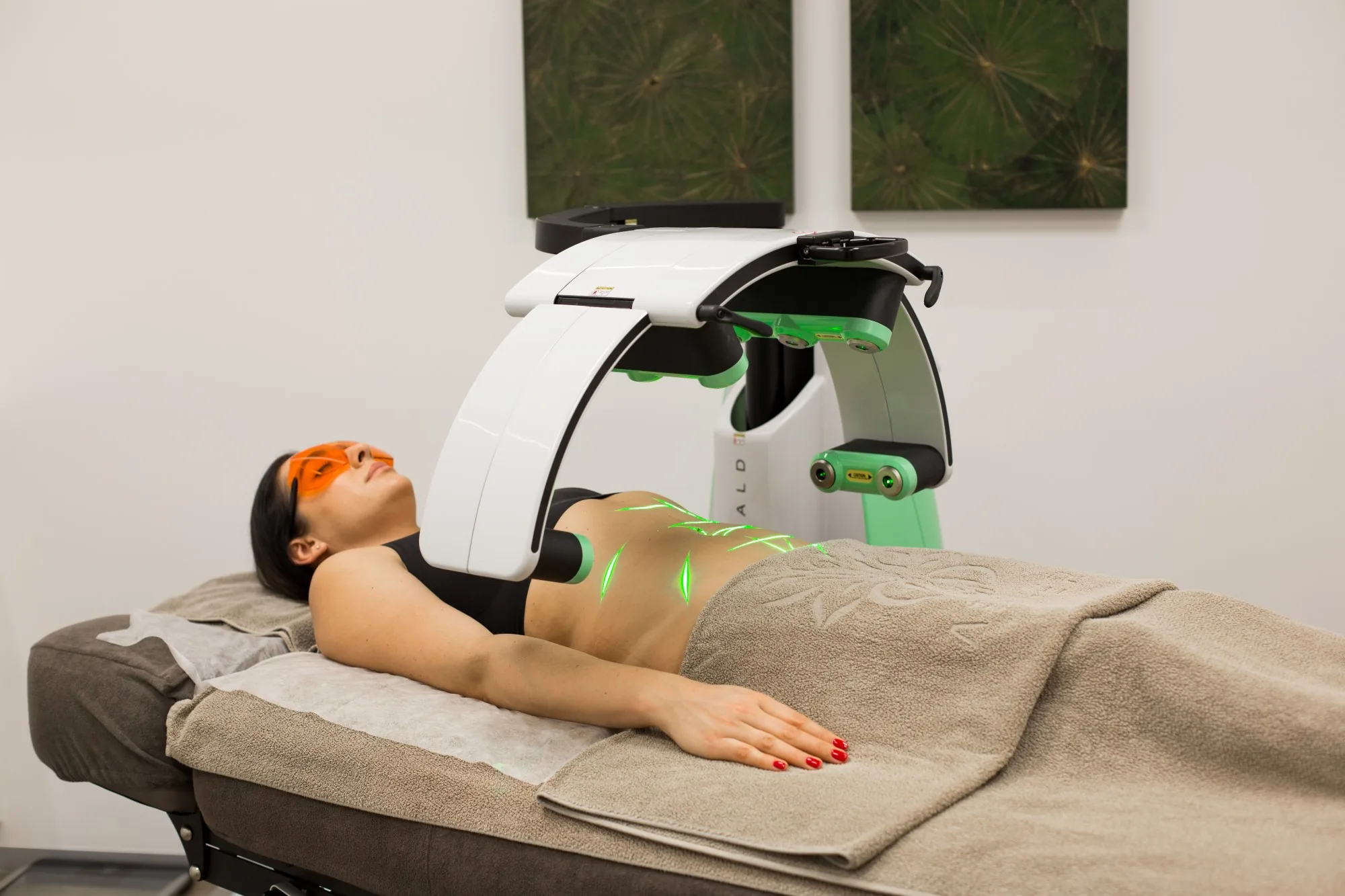 Patientin während einer Emerald-Laser-Behandlung, das grüne Licht liegt auf der Bauchpartie