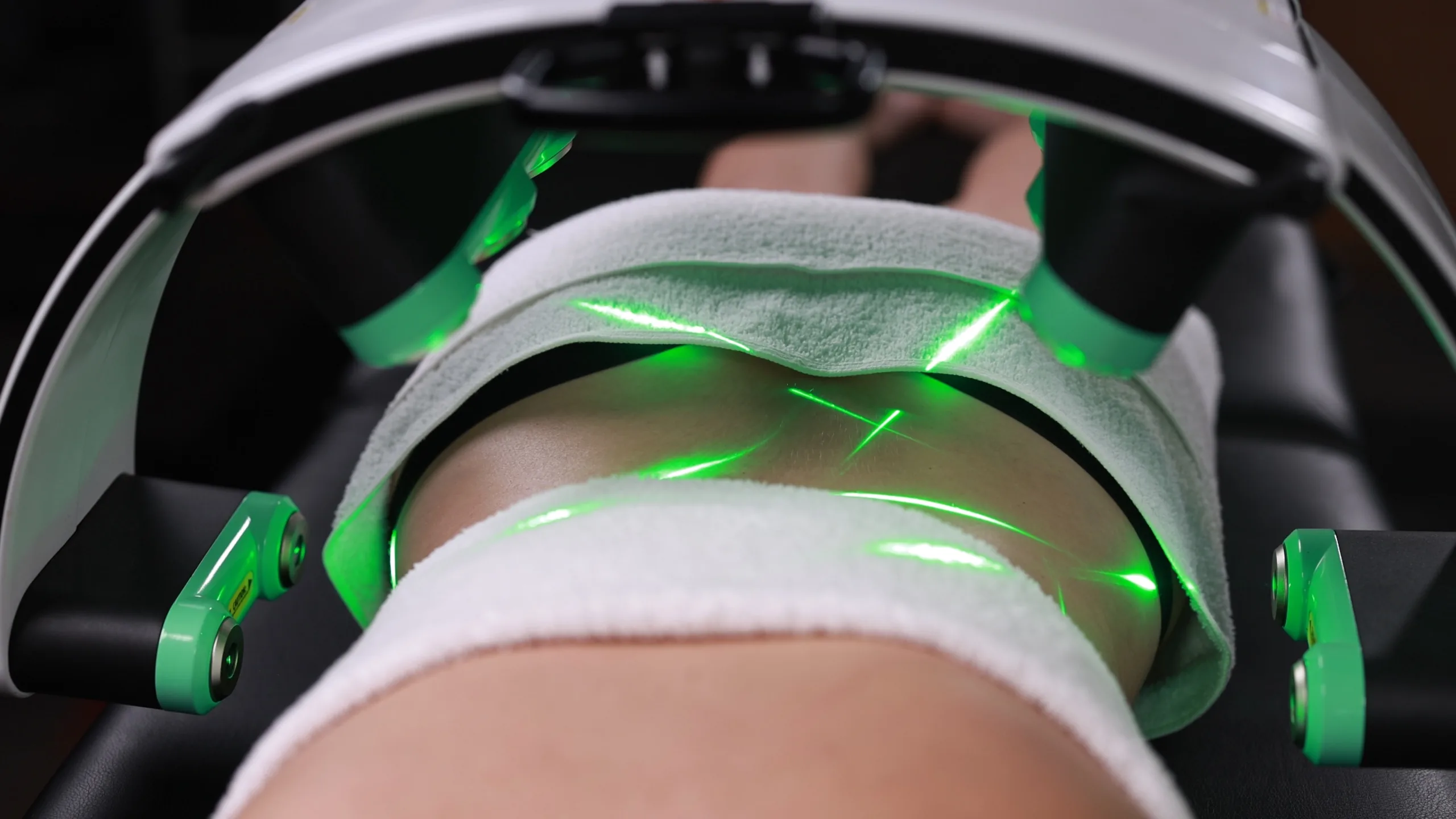 Emerald Laser über dem Oberschenkel einer Patientin im Pantheon Aesthetic Center Köln